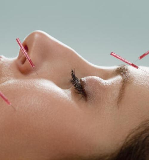 ACUPUNTURA ESTÉTICA ACUPUNTURA ESTÉTICA